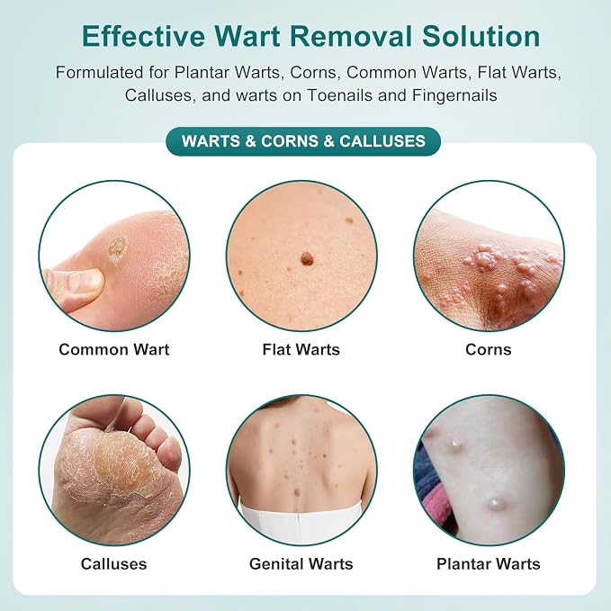 Tag Removal Wart Remover Fast Acting Gel – Maximum Strength Freeze Off Ointmen - Image 2
