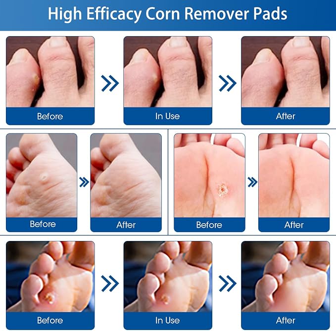 38 Count Corn Removal Pads for Feet and Toe, Corn Plasters Feet Remover for - Image 5