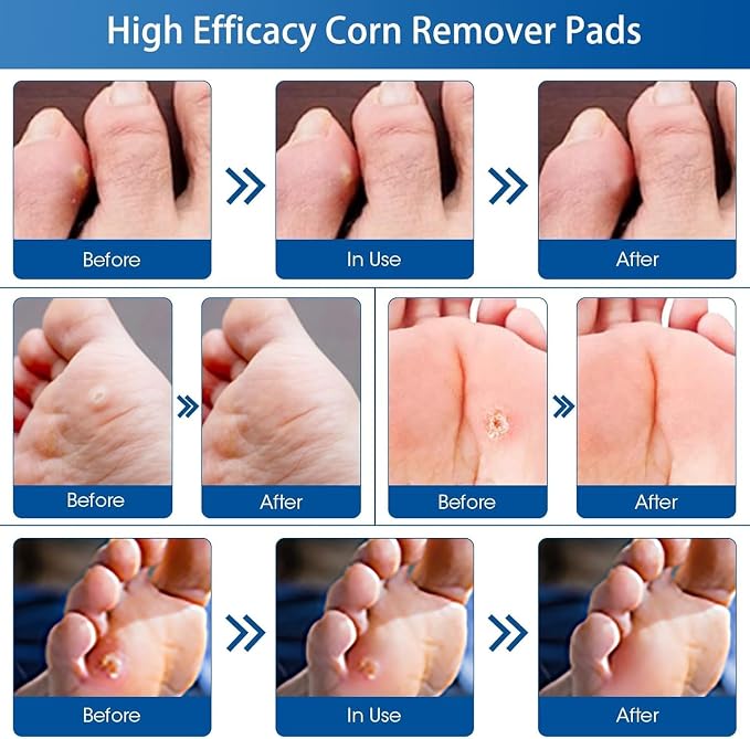 48 Count Corn Removal Pads for Feet and Toe, Corn Feet Remover for Extra - Image 7